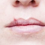 Herpes virus